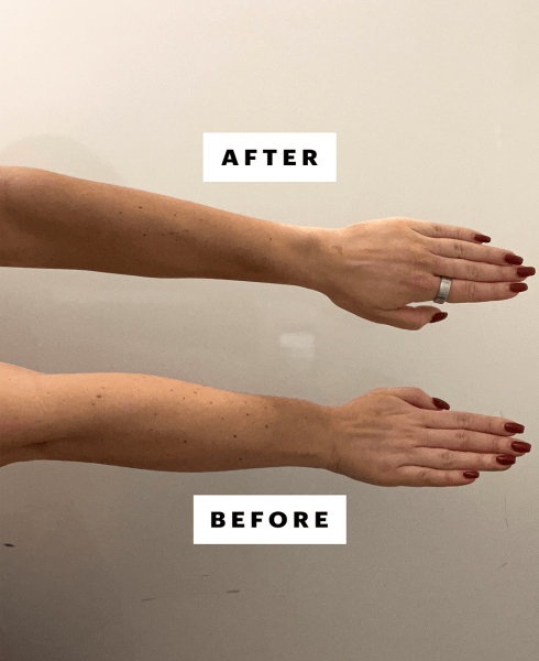 A photo of the writer's right arm untanned and left arm tanned after two hours